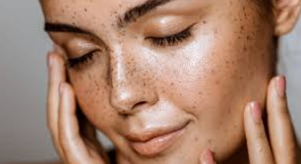 5 Ways How to treat freckles on the face?